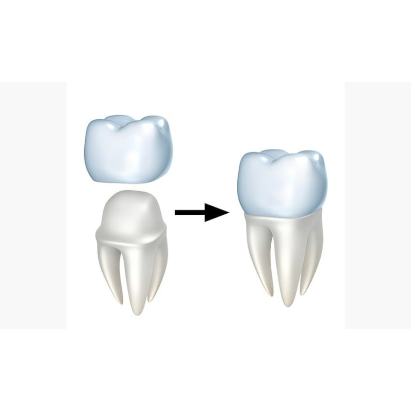 PFM High-Precious (74% Gold) Maryland Bridge