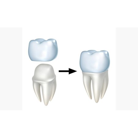 PFM Non-Precious Cantilever Bridge