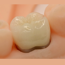 FMZ-T (translucent) Crown