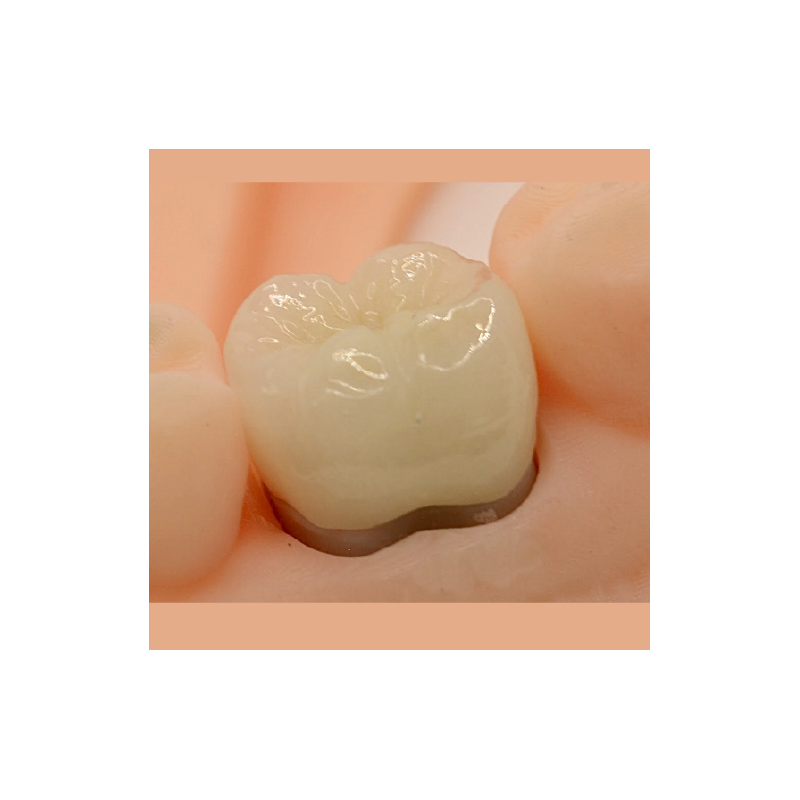 FMZ-T (translucent) Crown