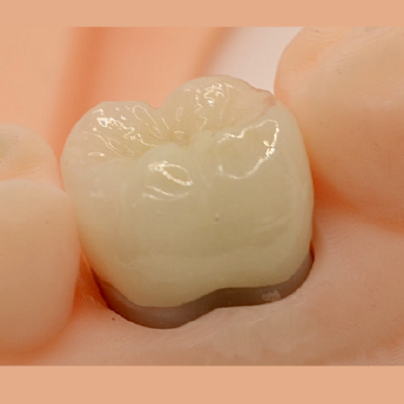 FMZ-T (translucent) Crown