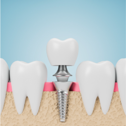 Implant & PFM Non-Precious Crown