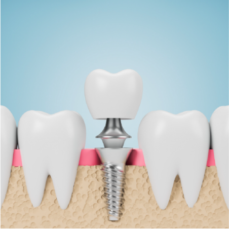 Implant & PFM Non-Precious Crown
