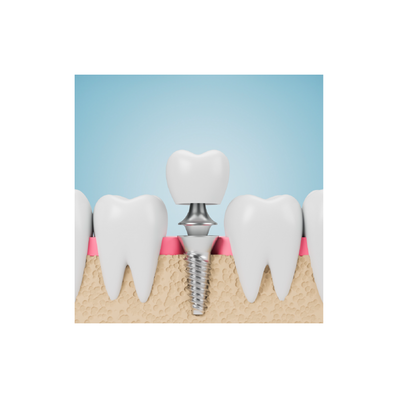 Implant & IPS e.max (layered) Crown