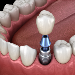 Implant & PFM High-Precious (74% Gold) Crown