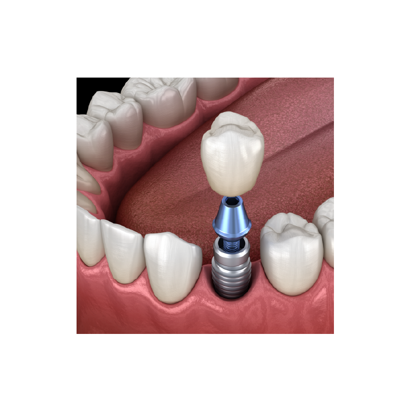 Implant & PFM High-Precious (74% Gold) Crown