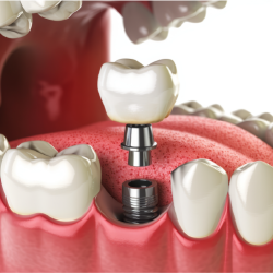 Implant & IPS e.max CAD Crown