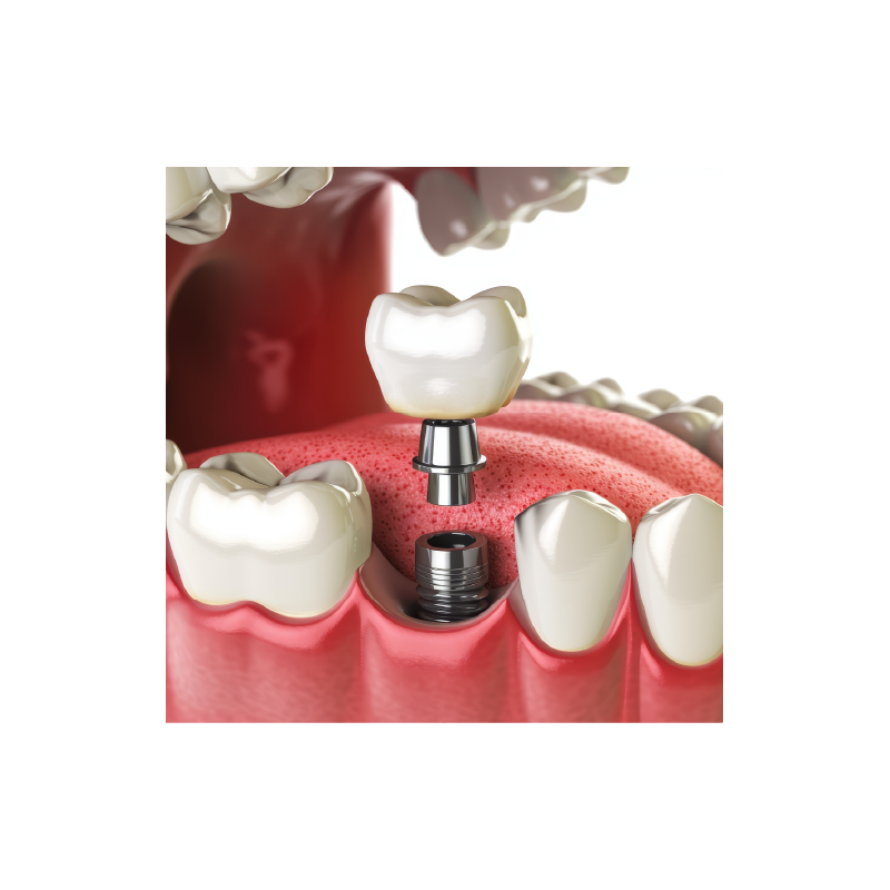 Implant & IPS e.max CAD Crown