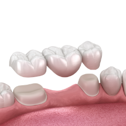 IPS e.max (layered) Bridge