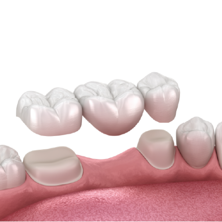 IPS e.max (layered) Bridge