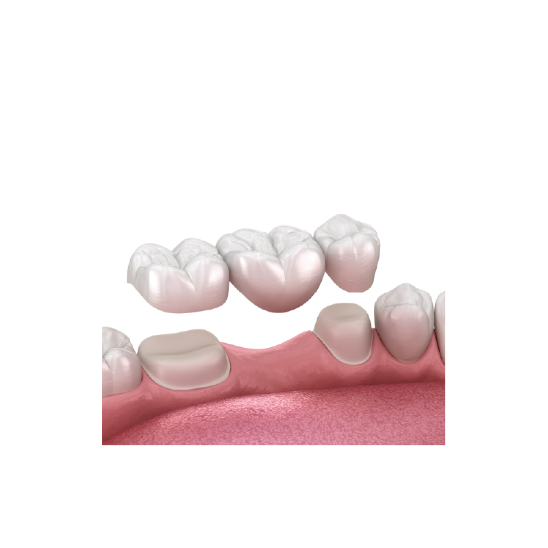 MAC (Metal Reinforced All Ceramic) Bridge