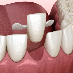 PFM Non-Precious Maryland Bridge