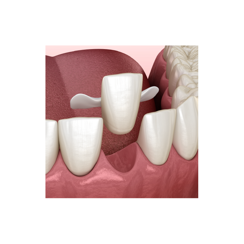 PFM Non-Precious Maryland Bridge