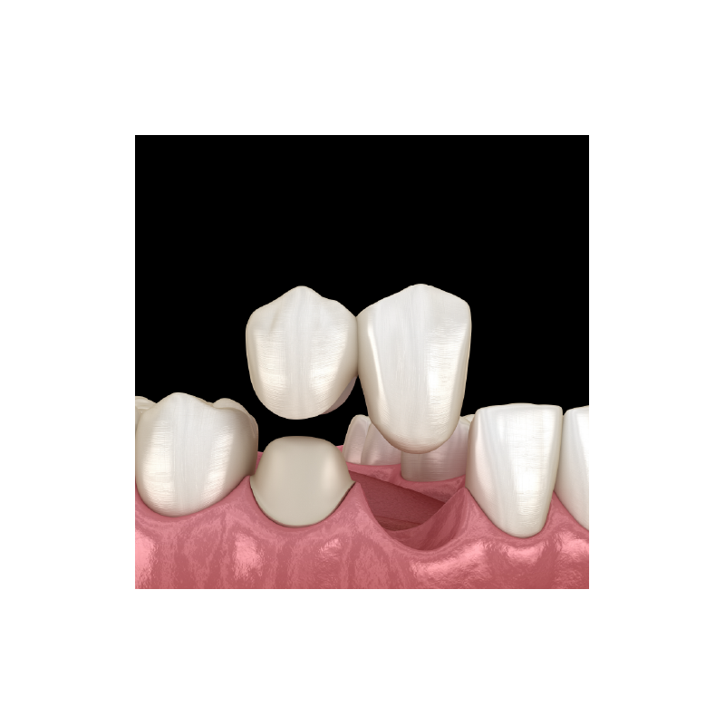 PFM Non-Precious Cantilever Bridge