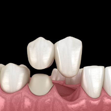 PFM Non-Precious Cantilever Bridge