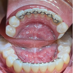 Infinity Fixed Lingual Retainer (Lower)