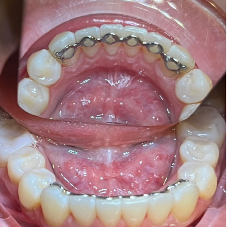 Infinity Fixed Lingual Retainer (Lower)