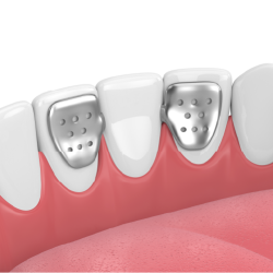 PFM High-Precious (40% Gold) Maryland Bridge