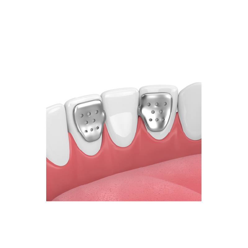 PFM Semi-Precious Maryland Bridge