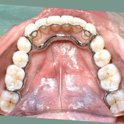 Infinity Fixed Lingual Retainer (Lower) with Atlas (Lower)