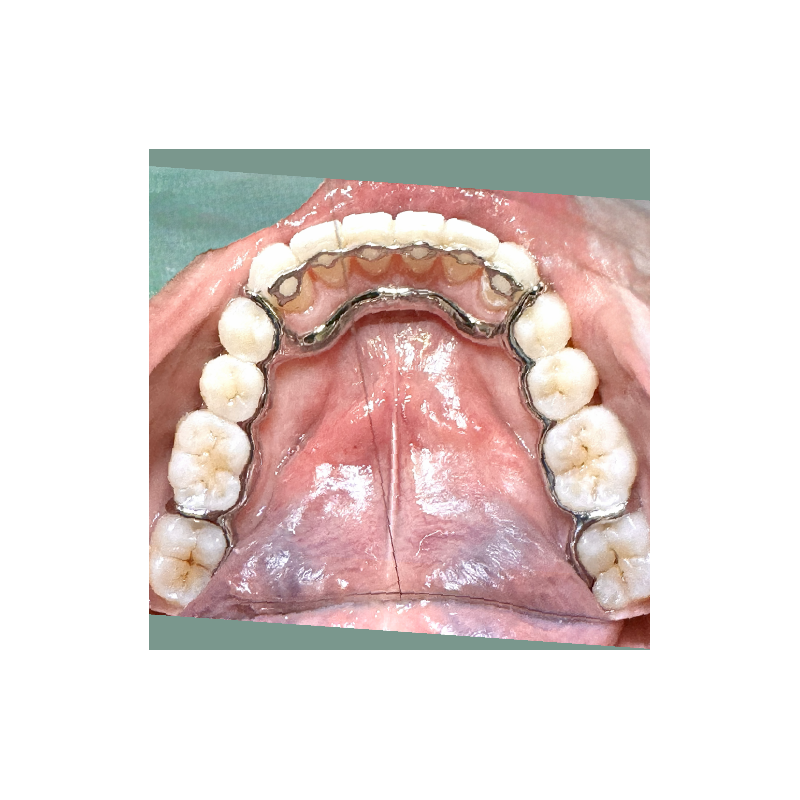 Infinity Fixed Lingual Retainer (Lower) with Atlas (Lower)