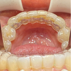 Infinity Fixed Lingual Retainer (Lower) and Hercules (Lower)