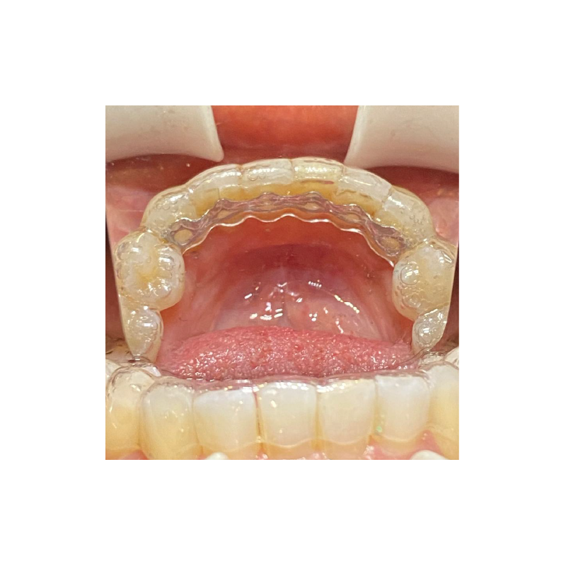Infinity Fixed Lingual Retainer (Lower) and Hercules (Lower)