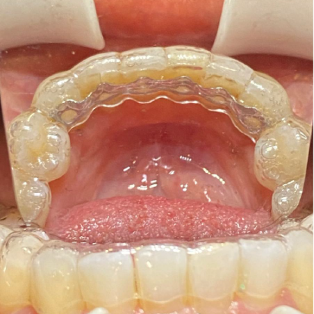 Infinity Fixed Lingual Retainer (Lower) and Hercules (Lower)