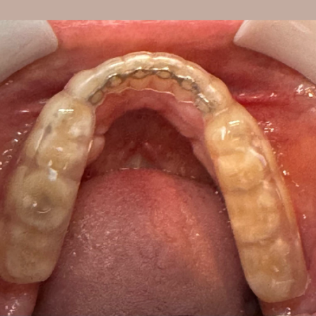 Infinity Fixed Lingual Retainer (Lower) and Hercules (Lower)