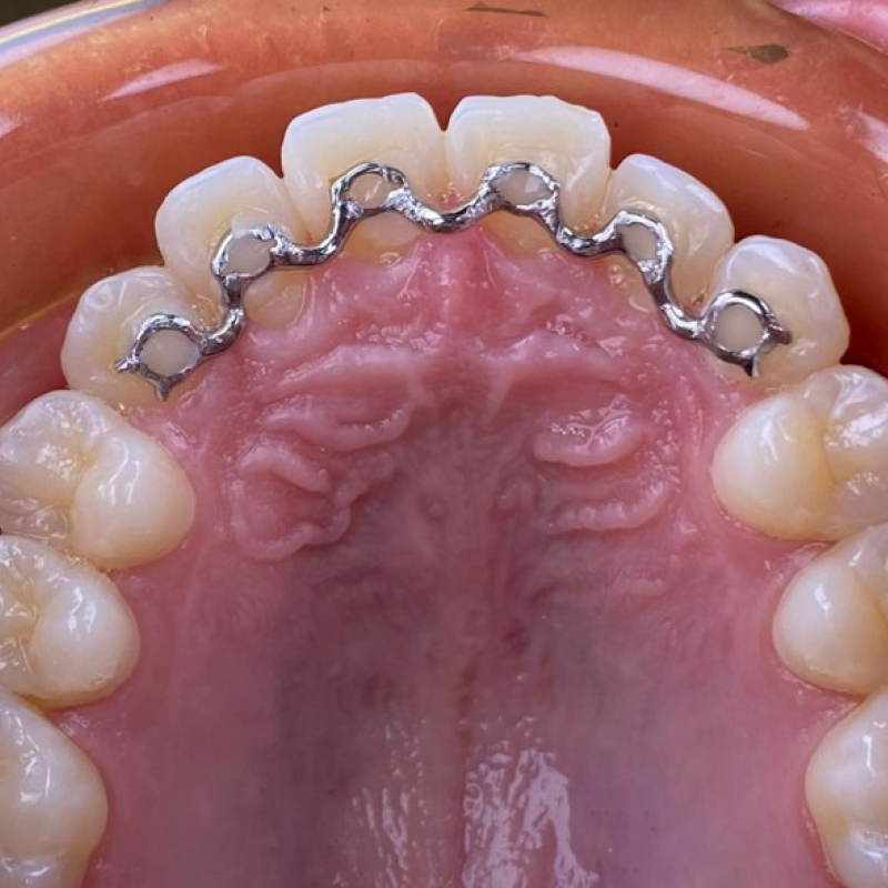 Infinity Fixed Lingual Retainer