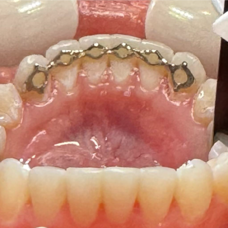 Infinity Fixed Lingual Retainer (Upper & Lower set) - Cobalt Chromium