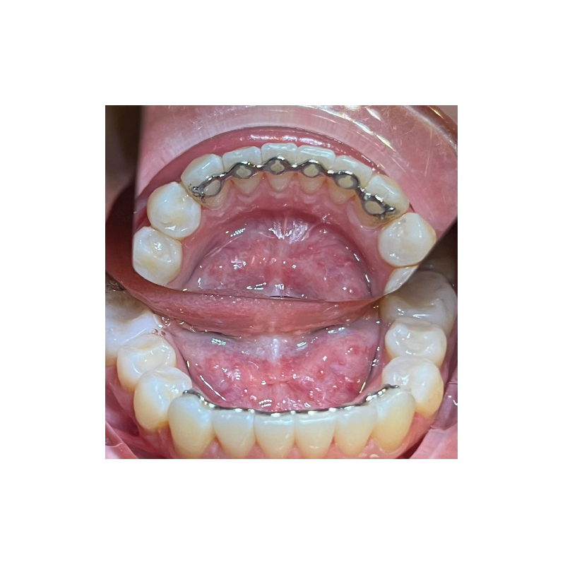 Infinity Fixed Lingual Retainer (Upper & Lower set) - Cobalt Chromium