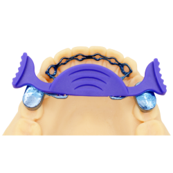 Infinity Fixed Lingual Retainer (Upper & Lower set) - Titanium