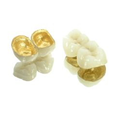 PFM High-Precious Metal Crown (75% Gold)