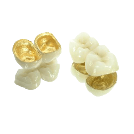 PFM High-Precious Metal Crown (75% Gold)