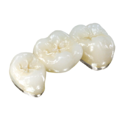 PFM High-Precious Metal Crown (40% Gold)