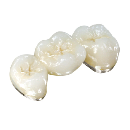 PFM High-Precious Metal Crown (40% Gold)